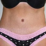 Tummy Tuck Before & After Patient #5590