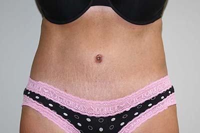 Tummy Tuck Before & After Patient #5590