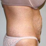 Tummy Tuck Before & After Patient #5590