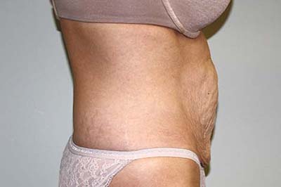 Tummy Tuck Before & After Patient #5590