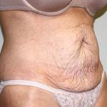 Tummy Tuck Before & After Patient #5590