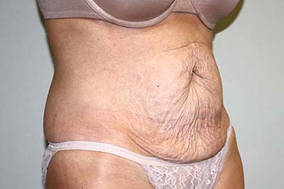 Tummy Tuck Before & After Patient #5590