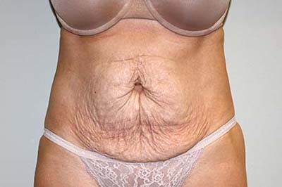 Tummy Tuck Before & After Patient #5590