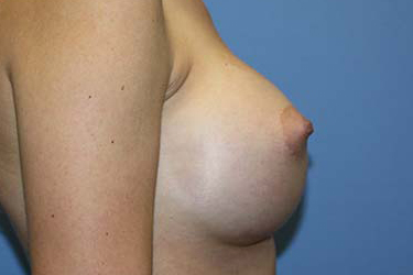 Breast Augmentation Before & After Patient #7089