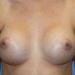 Breast Augmentation Before & After Patient #7089