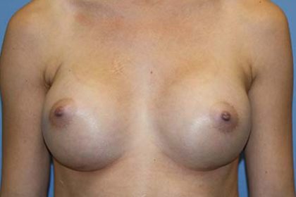 Breast Augmentation Before & After Patient #7089