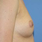 Breast Augmentation Before & After Patient #7089