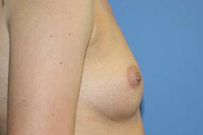 Breast Augmentation Before & After Patient #7089