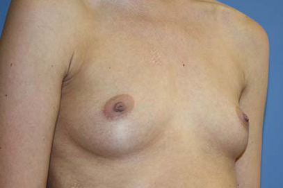 Breast Augmentation Before & After Patient #7089
