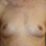 Breast Augmentation Before & After Patient #7089