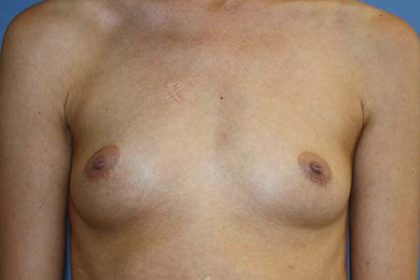 Breast Augmentation Before & After Patient #7089