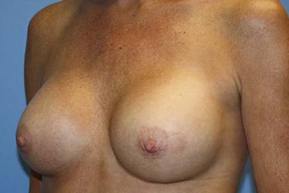 Breast Augmentation Before & After Patient #7101