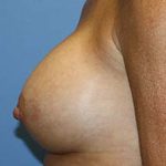 Breast Augmentation Before & After Patient #7101