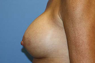 Breast Augmentation Before & After Patient #7101