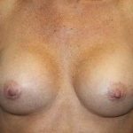 Breast Augmentation Before & After Patient #7101