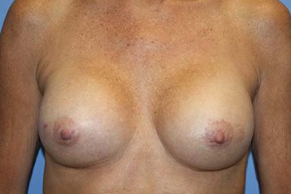 Breast Augmentation Before & After Patient #7101