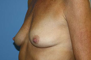 Breast Augmentation Before & After Patient #7101