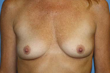 Breast Augmentation Before & After Patient #7101