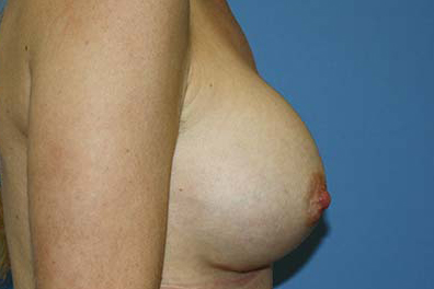 Breast Augmentation Before & After Patient #5763