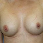 Breast Augmentation Before & After Patient #5763