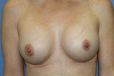 Breast Augmentation Before & After Patient #5763