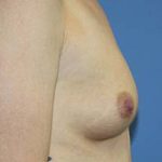 Breast Augmentation Before & After Patient #5763