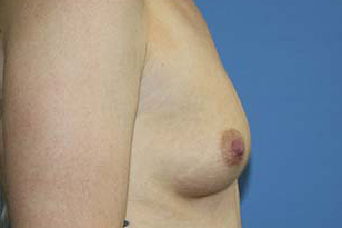 Breast Augmentation Before & After Patient #5763