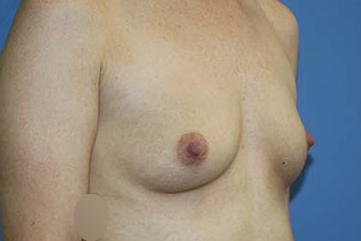 Breast Augmentation Before & After Patient #5763