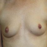 Breast Augmentation Before & After Patient #5763