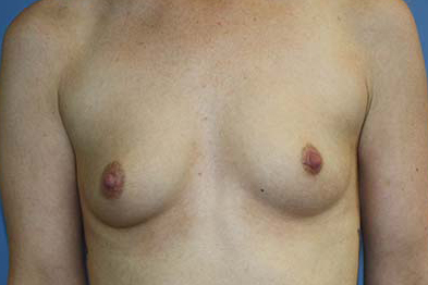 Breast Augmentation Before & After Patient #5763