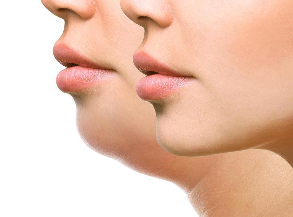 Chin and Jaw Enhancement