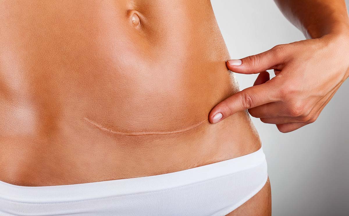 Tummy Tuck Scars: Position, Healing, and Treatment