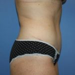 Tummy Tuck Before & After Patient #7790