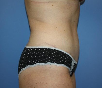 Tummy Tuck Before & After Patient #7790