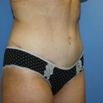 Tummy Tuck Before & After Patient #7790