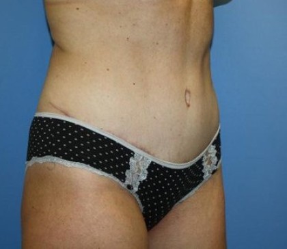 Tummy Tuck Before & After Patient #7790