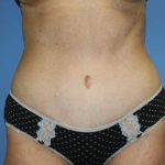 Tummy Tuck Before & After Patient #7790