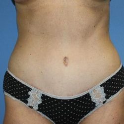 Tummy Tuck Before & After Patient #7790