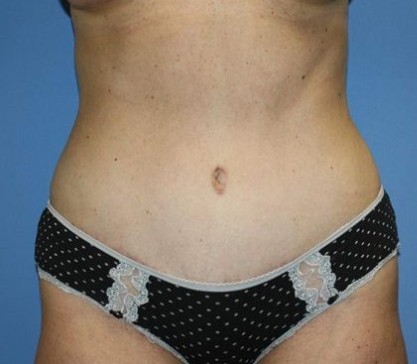 Tummy Tuck Before & After Patient #7790