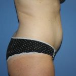 Tummy Tuck Before & After Patient #7790