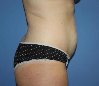 Tummy Tuck Before & After Patient #7790