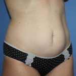 Tummy Tuck Before & After Patient #7790