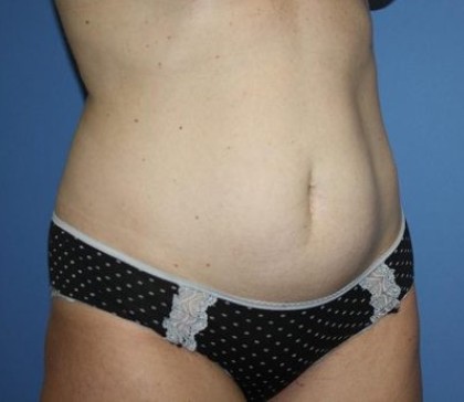 Tummy Tuck Before & After Patient #7790