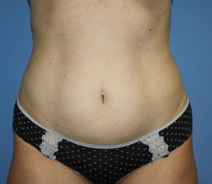 Tummy Tuck Before & After Patient #7790